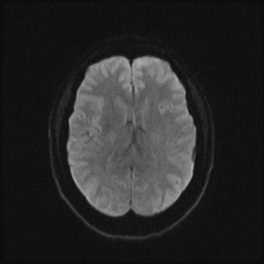 Cavernous sinus meningioma (Radiopaedia 63682-72367 DWI 34).jpg