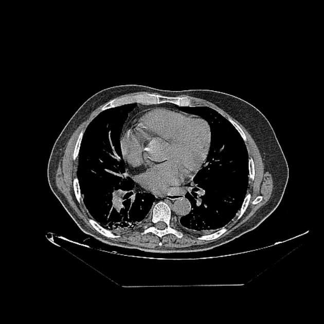 Cavitating bronchogenic carcinoma (Radiopaedia 44489-48162 Axial non-contrast 52).jpg