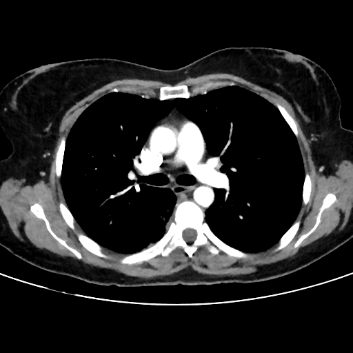 File:Cavitating lung mass - squamous cell carcinoma (Radiopaedia 48047-52854 B 21).png