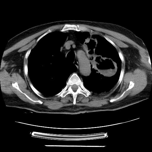 Cavitating pulmonary metastases (Radiopaedia 89545-106544 Axial non-contrast 15).jpg