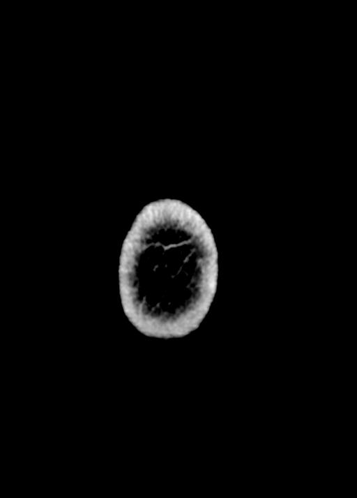 Cavum septum pellucidum and cavum vergae (Radiopaedia 77797-90060 Axial Brain Window 109).jpg