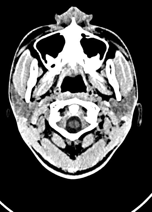 Cavum septum pellucidum and cavum vergae (Radiopaedia 77797-90060 Axial Brain Window 2).jpg