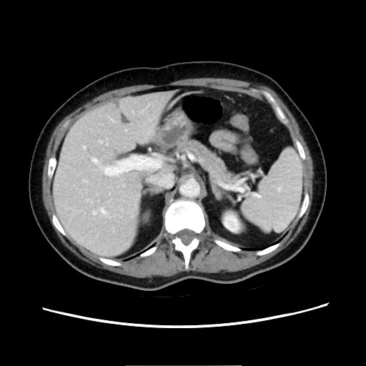 Cecal adenocarcinoma (Radiopaedia 75909-87331 A 28).jpg