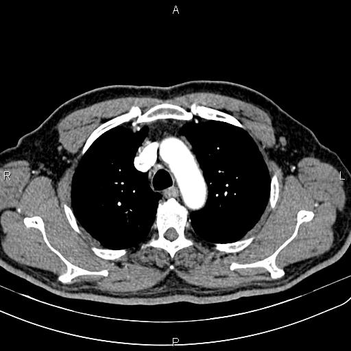 File:Cecal cancer with appendiceal mucocele (Radiopaedia 91080-108651 A 20).jpg