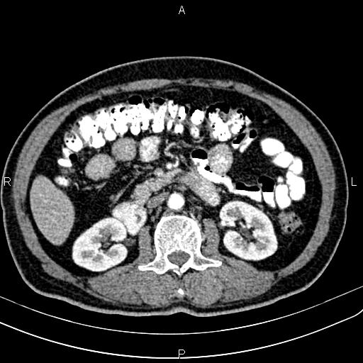 File:Cecal cancer with appendiceal mucocele (Radiopaedia 91080-108651 A 84).jpg