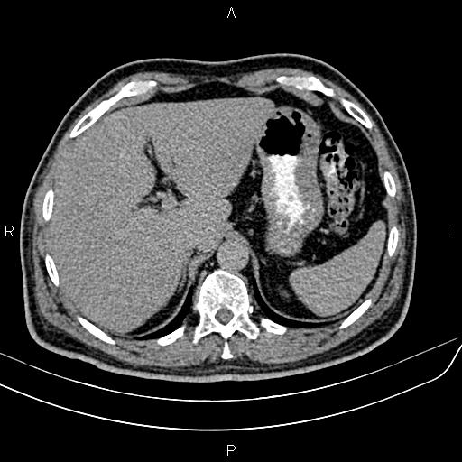 File:Cecal cancer with appendiceal mucocele (Radiopaedia 91080-108651 Axial C+ delayed 3).jpg