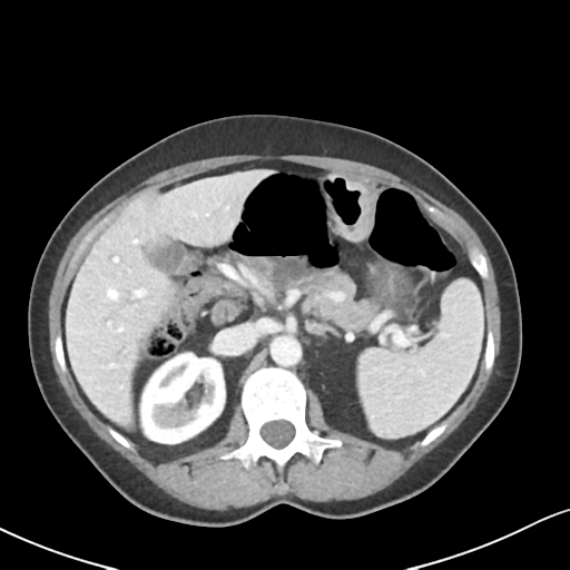 Cecal internal hernia through the foramen of Winslow (Radiopaedia 44820-48651 B 24).png