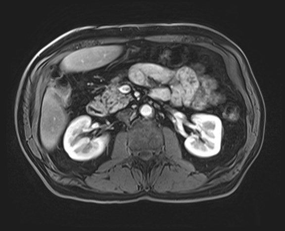 File:Cecal mass causing appendicitis (Radiopaedia 59207-66532 H 60).jpg