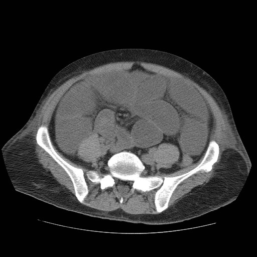 Cecal volvulus (Radiopaedia 28294-28534 Axial non-contrast 70).jpg