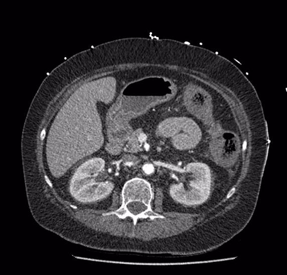 File:Celiac artery severe stenosis and dissection (Radiopaedia 44128-47842 B 34).jpg