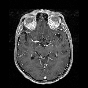 Central-variant posterior reversible encephalopathy syndrome (PRES) (Radiopaedia 43880-47358 Axial T1 C+ 67).jpg