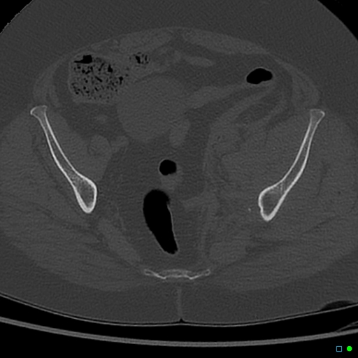 Central fracture-dislocation of the acetabulum (Radiopaedia 36578-38150 Axial bone window 36).jpg