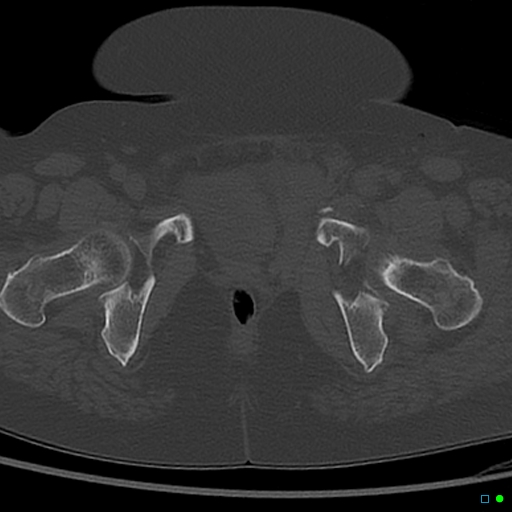 Central fracture-dislocation of the acetabulum (Radiopaedia 36578-38150 Axial bone window 72).jpg