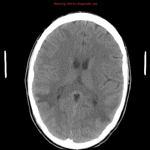 File:Central nervous system vasculitis (Radiopaedia 8410-9234 Axial non-contrast 15).jpg