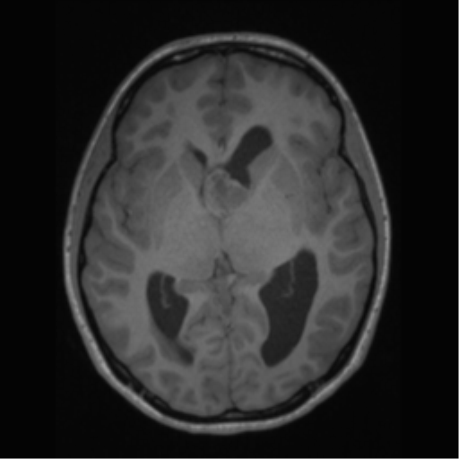 File:Central neurocytoma (Radiopaedia 37664-39557 Axial T1 35).png