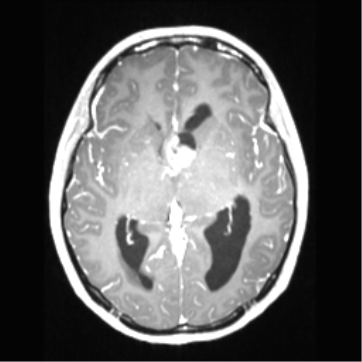 File:Central neurocytoma (Radiopaedia 37664-39557 Axial T1 C+ 39).png