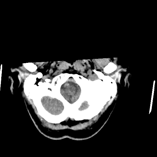 File:Central neurocytoma (Radiopaedia 65317-74346 Axial non-contrast 6).png