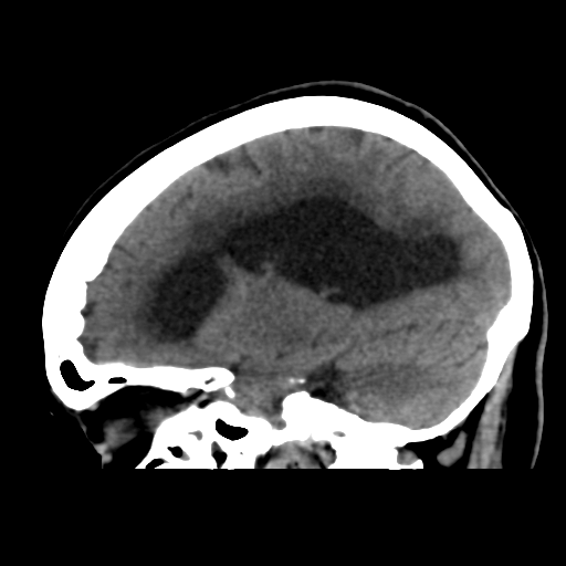 File:Central neurocytoma (Radiopaedia 65317-74346 C 34).png