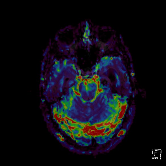 Central neurocytoma (Radiopaedia 84497-99872 Axial Perfusion 230).jpg