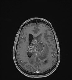 Central neurocytoma (Radiopaedia 84497-99872 Axial T1 C+ 99).jpg