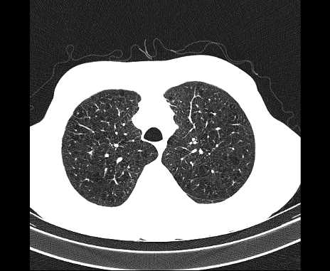 Centrilobular pulmonary emphysema (Radiopaedia 62468-70718 Axial lung window 17).jpg