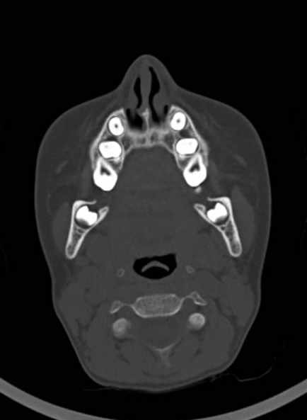 Cerebellar abscess (Radiopaedia 73727-84527 Axial bone window 8).jpg