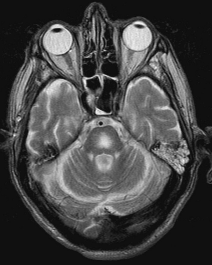 Cerebellar abscess (Radiopaedia 78135-90671 Axial non-contrast 20).jpg