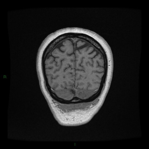 Cerebellar abscess (Radiopaedia 78135-90678 Coronal T1 C+ 146).jpg