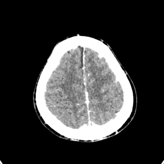 Cerebellar abscess secondary to mastoiditis (Radiopaedia 26284-26412 Axial C+ delayed 133).jpg