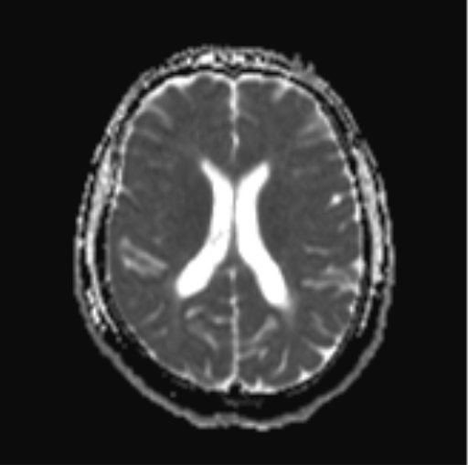 File:Cerebellar hemangioblastomas and pituitary adenoma (Radiopaedia 85490-101176 Axial ADC 21).png