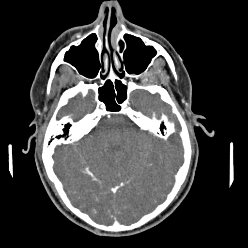 Cerebellar infarct due to vertebral artery dissection with posterior fossa decompression (Radiopaedia 82779-97029 C 7).png