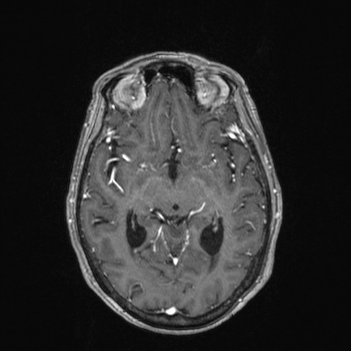 Cerebellar metastases (Radiopaedia 24038-24249 Axial T1 C+ 19).jpg