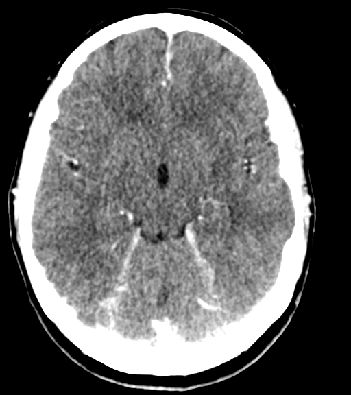 File:Cerebellar metastases - colorectal adenocarcinoma (Radiopaedia 40947-43652 Axial C+ 23).png