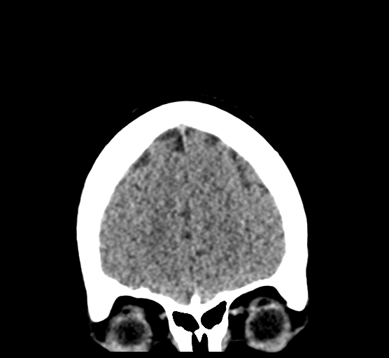 File:Cerebellar metastases - colorectal adenocarcinoma (Radiopaedia 40947-43652 Coronal non-contrast 19).png