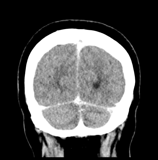 Cerebellar metastasis (Radiopaedia 54578-60812 Coronal C+ 53).png