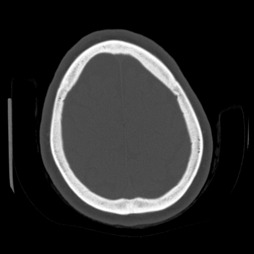 File:Cerebellar metastasis (cystic appearance) (Radiopaedia 41395-44258 Axial bone window 57).png