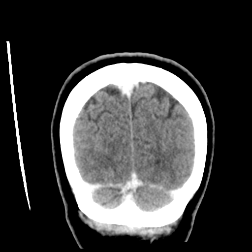 Cerebellar metastasis (cystic appearance) (Radiopaedia 41395-44258 D 53).png