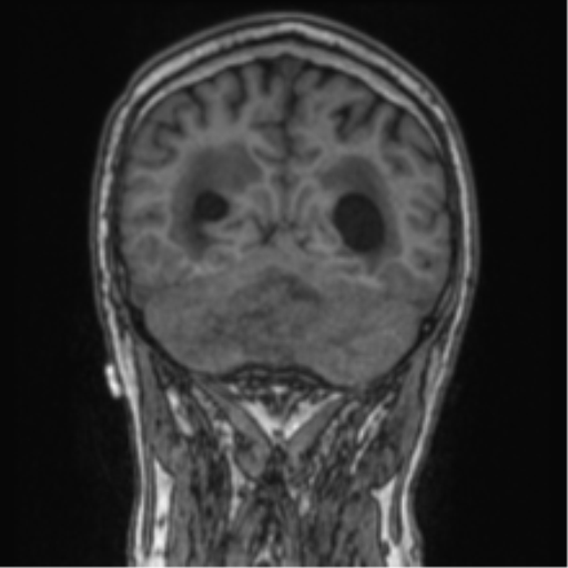 Cerebellar metastasis from lung adenocarcinoma (Radiopaedia 86690-102829 Coronal T1 29).png