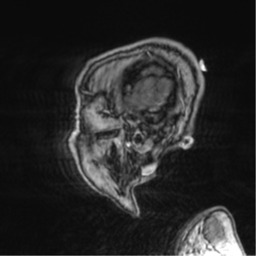 Cerebellar metastasis from lung adenocarcinoma (Radiopaedia 86690-102829 Sagittal T1 C+ 74).png