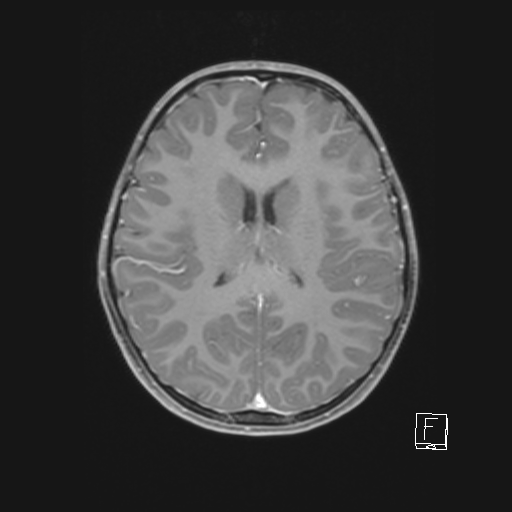 Cerebellar stroke (Radiopaedia 32202-33150 Axial T1 C+ 45).png