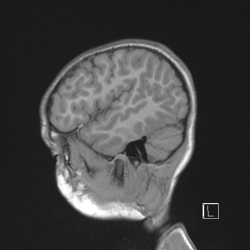 Cerebellar stroke (Radiopaedia 32202-33150 Sagittal T1 C+ 43).png