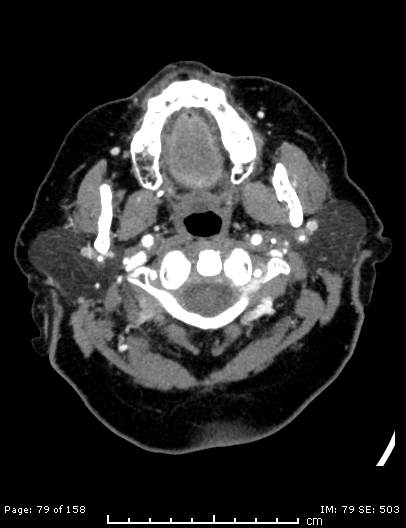 File:Cerebellar strokes due to intracranial giant cell arteritis (Radiopaedia 68799-78510 CT angiogram 79).jpg