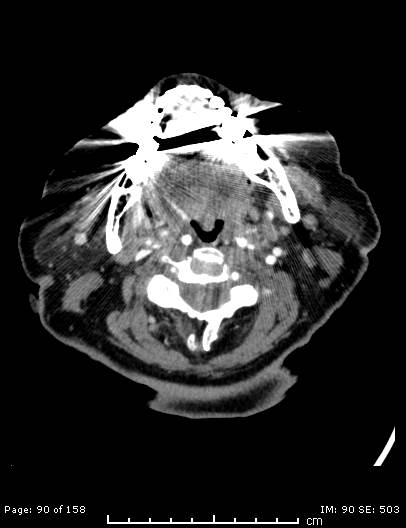 File:Cerebellar strokes due to intracranial giant cell arteritis (Radiopaedia 68799-78510 CT angiogram 90).jpg