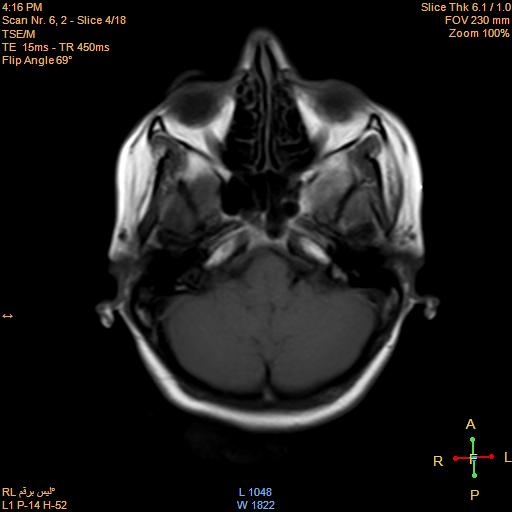 File:Cerebellopontine angle meningioma (Radiopaedia 22488-22525 Axial T1 3).jpg