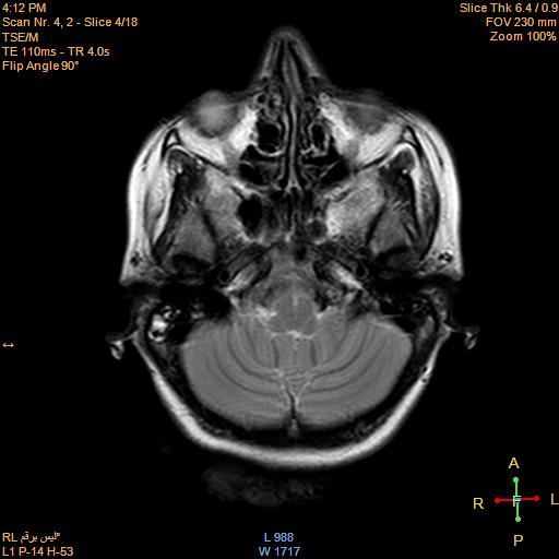 File:Cerebellopontine angle meningioma (Radiopaedia 22488-22525 Axial T2 2).jpg