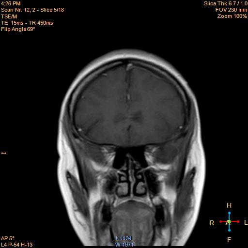 File:Cerebellopontine angle meningioma (Radiopaedia 22488-22525 Coronal T1 C+ 5).jpg
