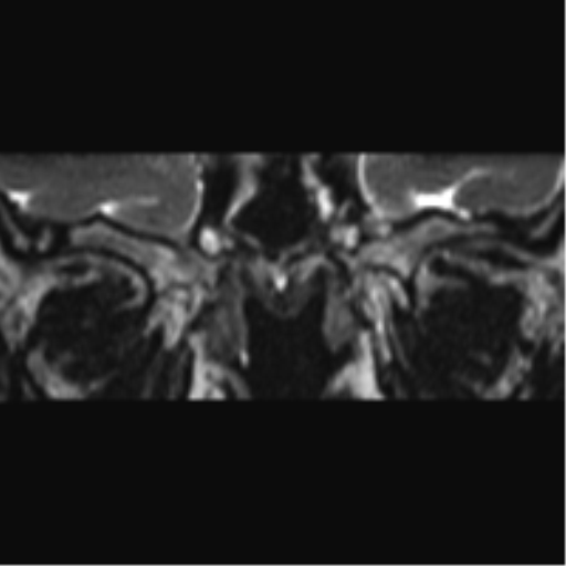 Cerebellopontine angle meningioma (Radiopaedia 48434-53348 Coronal T2 85).png