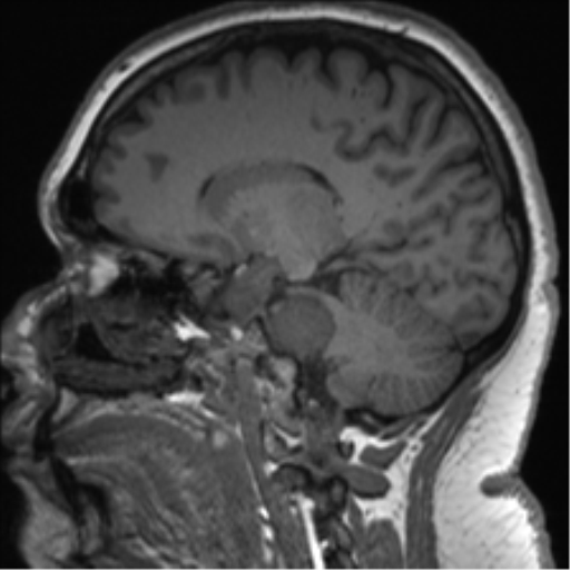 Cerebellopontine angle meningioma (Radiopaedia 48434-53348 Sagittal T1 40).png