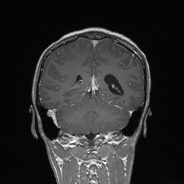 Cerebral abscess (Radiopaedia 24212-24478 Coronal T1 C+ 142).jpg