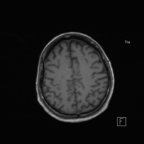 Cerebral abscess (Radiopaedia 26111-26247 Axial T1 43).jpg